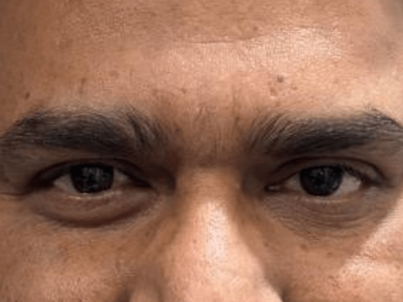 After Squint Surgery - 3D Vision Eye Hospital Jaipur