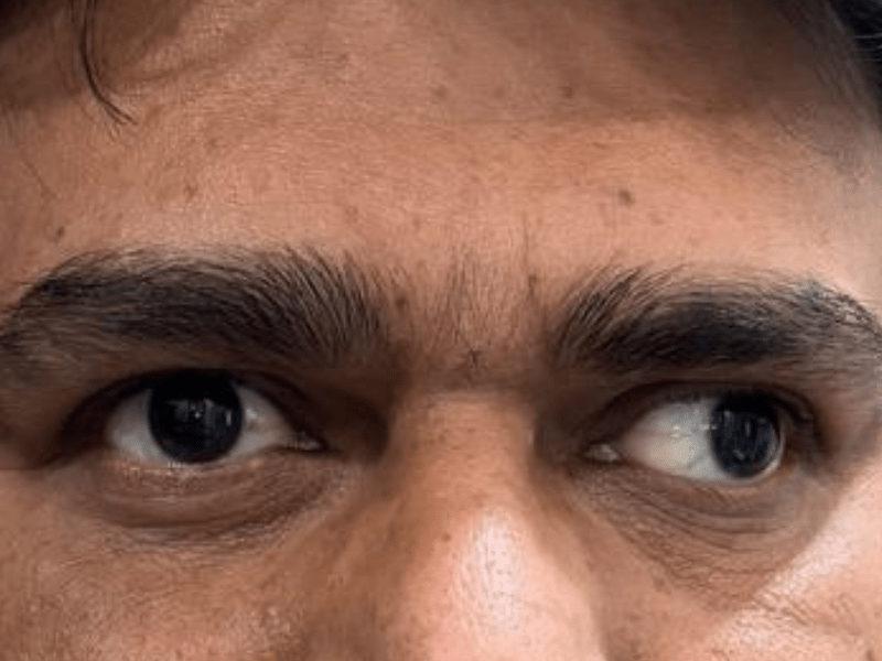 Before Squint Surgery - 3D Vision Eye Hospital Jaipur